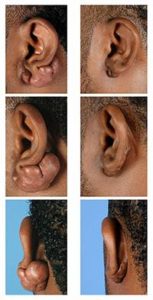 image keloid 2