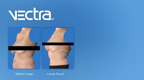 vectrafeature background breast reconstruction