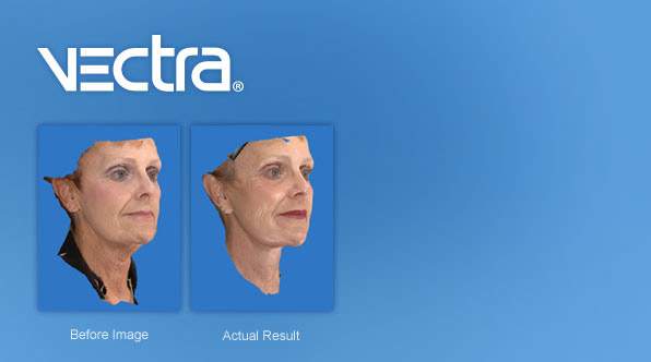 Facelift Mullica Hill NJ  Board Certified Facelift Surgeons Mullica Hill