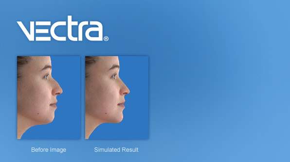 before & after predictive image of rhinoplasty using vectra's 3D imaging