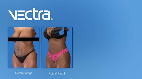vectrafeature background tummy tuck