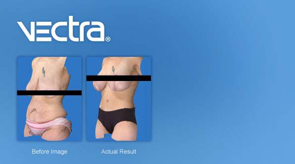 vectrafeature background weight loss