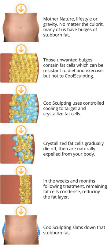 coolsculptingdiagram