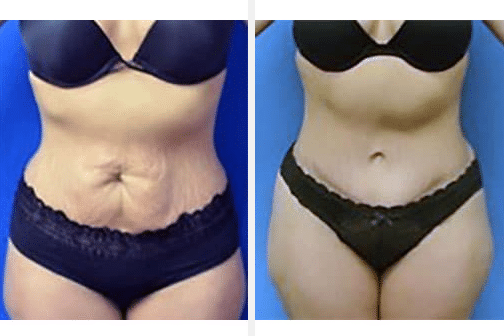 A before and after image of a tummy tuck patient