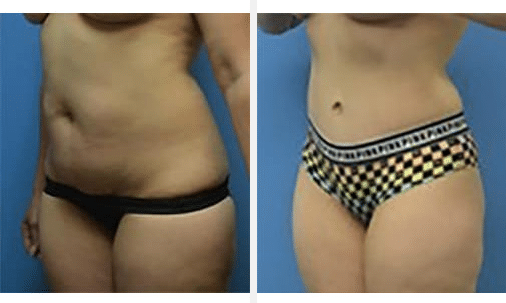 A before and after image of an abdominoplasty patient