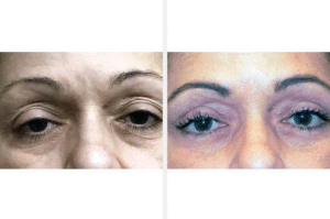 A before and after image of a blepharoplasty patient at American Surgical Arts