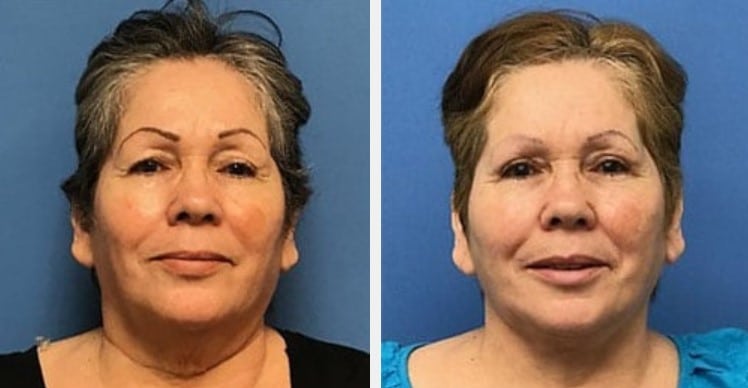 before & after photo of eyelid surgery