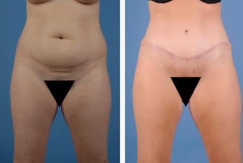 liposuction before & after photo