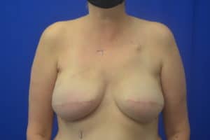 Post Op front 