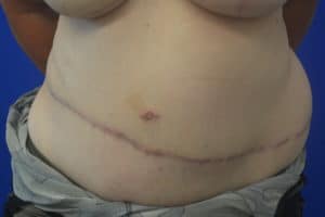 Post op Rt DIEP flap reconstruction Left Reduction 