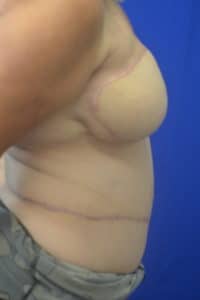 Post op Rt DIEP flap reconstruction Left Reduction 