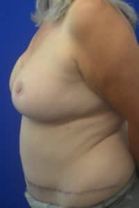 Post op Rt DIEP flap reconstruction Left Reduction 