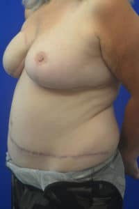 Post op Rt DIEP flap reconstruction Left Reduction 