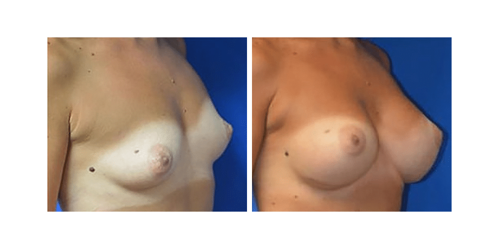 73296 case 2424 imageset 2 before after slide