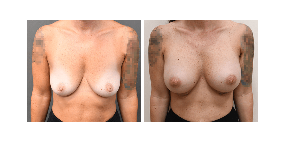 topless woman’s chest before and after breast augmentation, breasts larger after operation