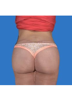 Buttock Augmentation