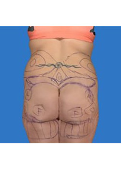 Buttock Augmentation