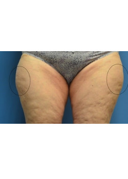 CoolSculpting