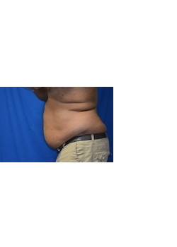 CoolSculpting