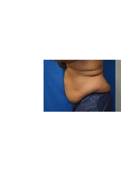 CoolSculpting