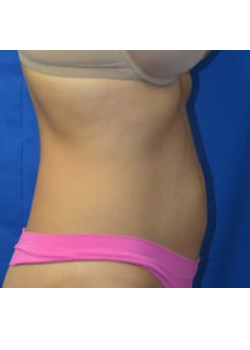 CoolSculpting