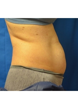 CoolSculpting