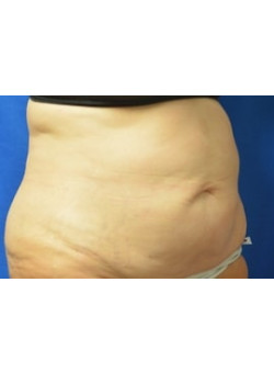 CoolSculpting