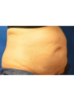 CoolSculpting