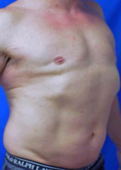 Gynecomastia