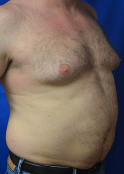 Gynecomastia