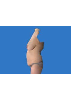 Liposuction