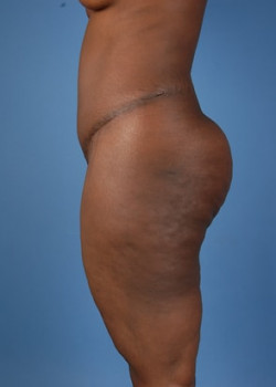 Liposuction