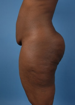 Liposuction