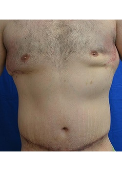 Surgery After Massive Weight Loss