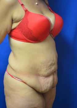Surgery After Massive Weight Loss