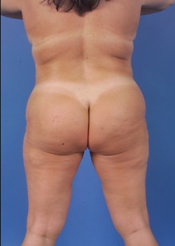 Tummy Tuck