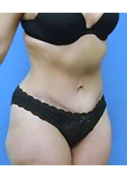 Tummy Tuck