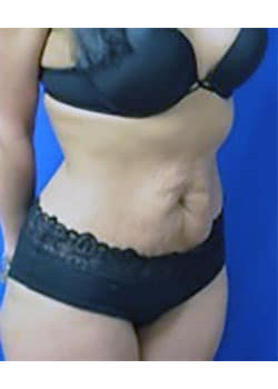 Tummy Tuck