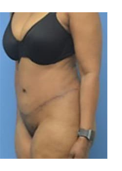 Tummy Tuck