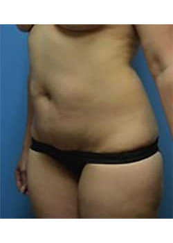 Tummy Tuck