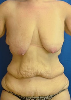 Surgery After Massive Weight Loss: Breast Lift with Implant and Lower Body Lift