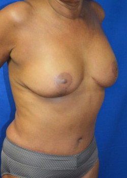 Tummy Tuck