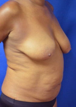 Tummy Tuck