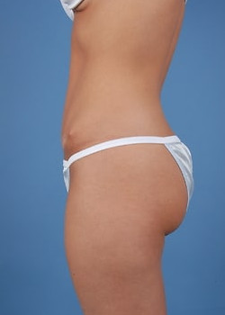 Tummy Tuck