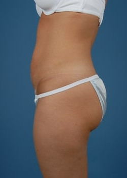 Tummy Tuck