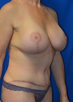 Tummy Tuck