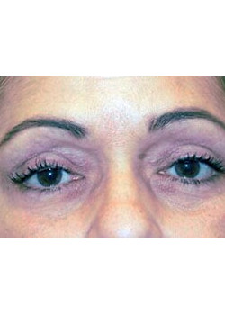 Blepharoplasty