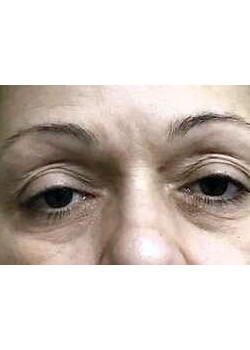 Blepharoplasty