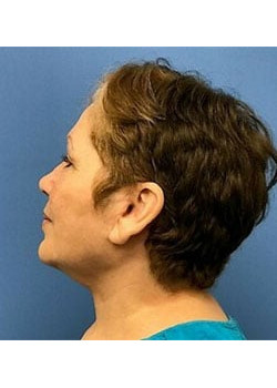 Facelift & Neck Lift