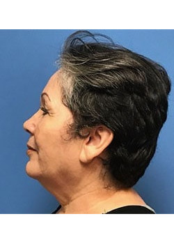 Facelift & Neck Lift